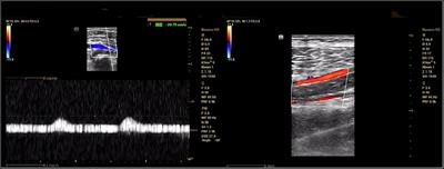 Compression syndromes of the popliteal artery due to intramuscular ganglion cyst of the biceps femoris: A case report and literature review